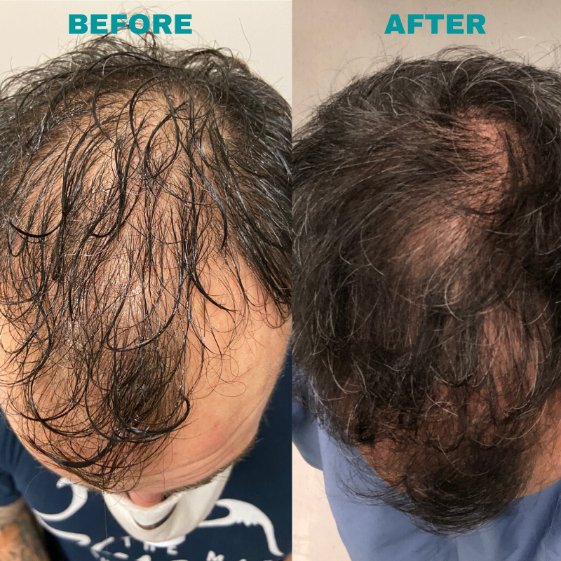 Before and after PRP hair treatments