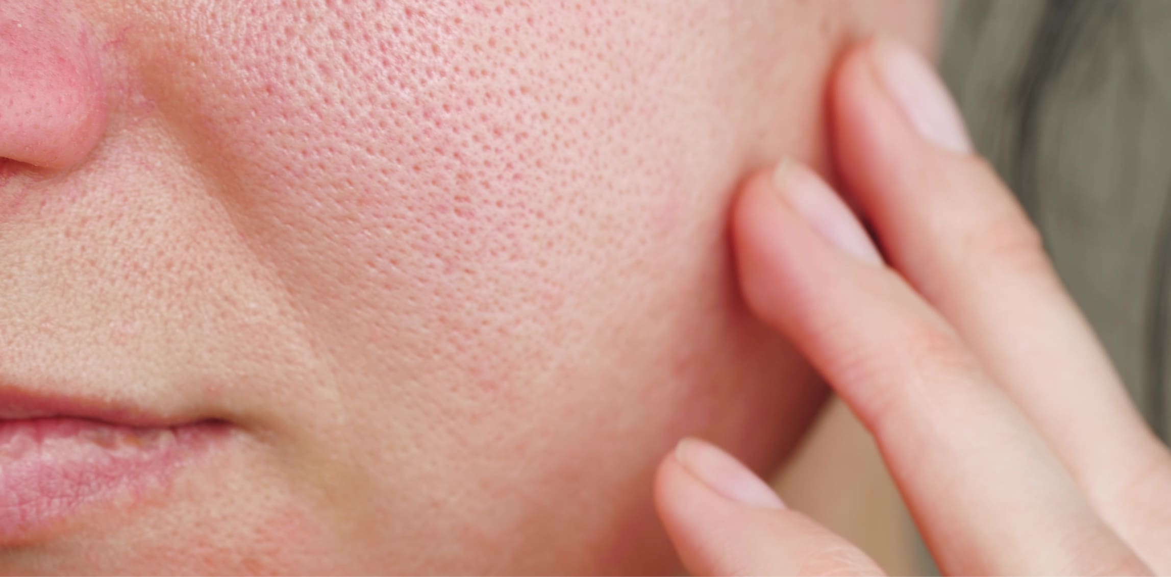 Enlarged Pores