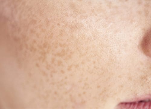 Hyperpigmentation on a person's face