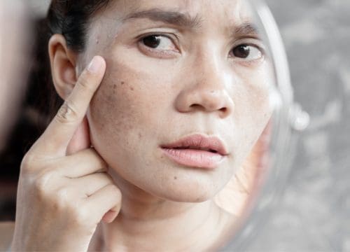 Woman with melasma touching her face