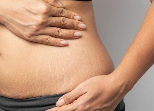 Stretch marks on a woman's body