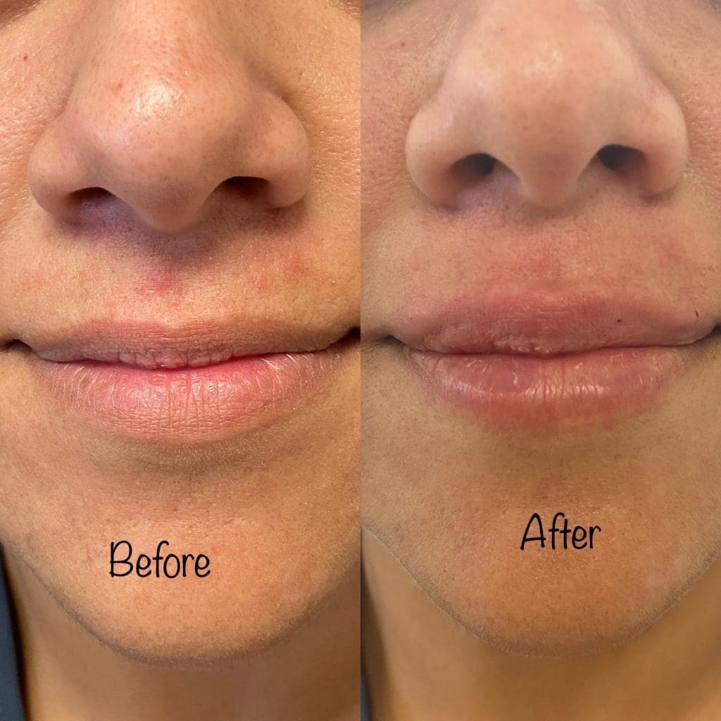 Before and after dermal filler results