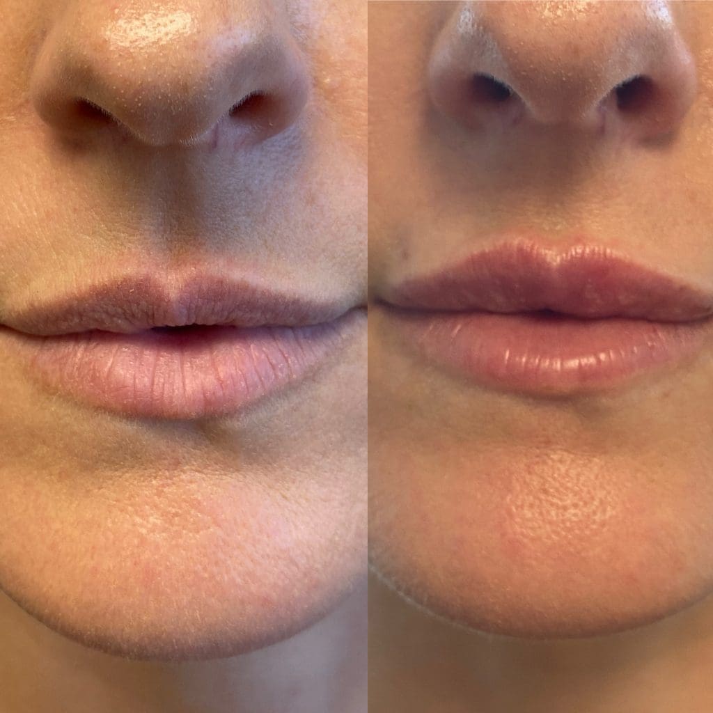 Before and after dermal filler results