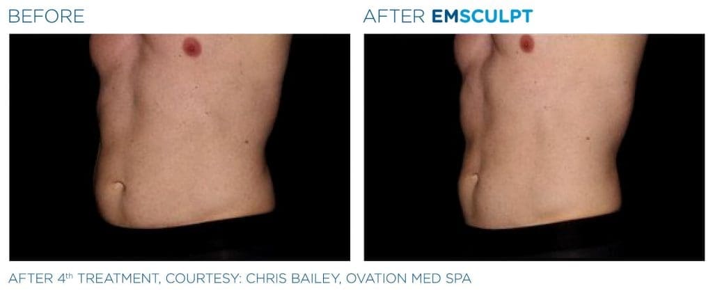 Before and after Emsculpt results