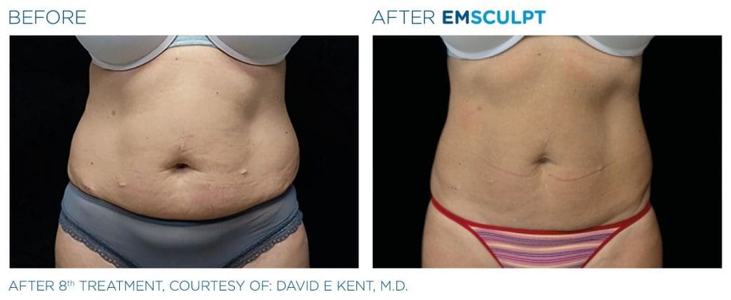 Before and after Emsculpt results